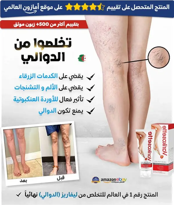 كريم علاج الدوالي