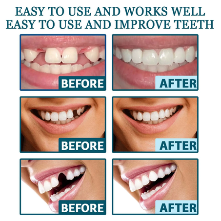 Instant Smile Teeth) هوليود سمايل الاصلي