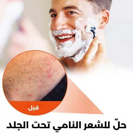 إزالة الشعر المنغرس