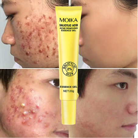 جل إزالة حب الشباب بحمض الساليسيليك-MOIKA