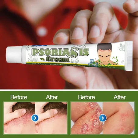 كريم  لعلاج الصدفية