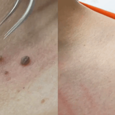 المرهم الاول في العالم لازالة الثآليل🌟 (نسخة) BFC3lCbeTVMxTE4fNI7lQ2Gewd0ni8Cy74JDVEn2