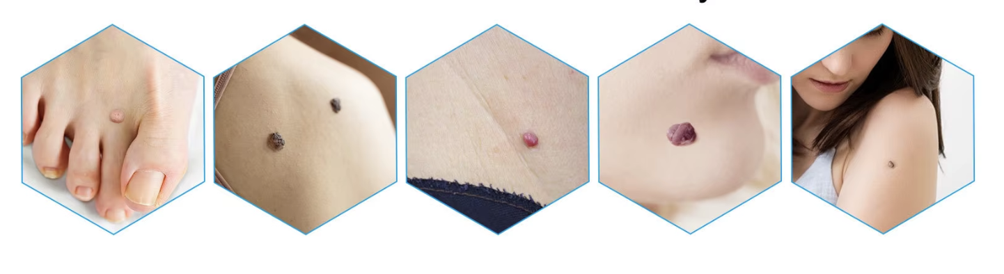 المرهم الاول في العالم لازالة الثآليل🌟 (نسخة) OarOY3okaUmm4aliocTqMEb4deSZFFKjTvoe6fUA