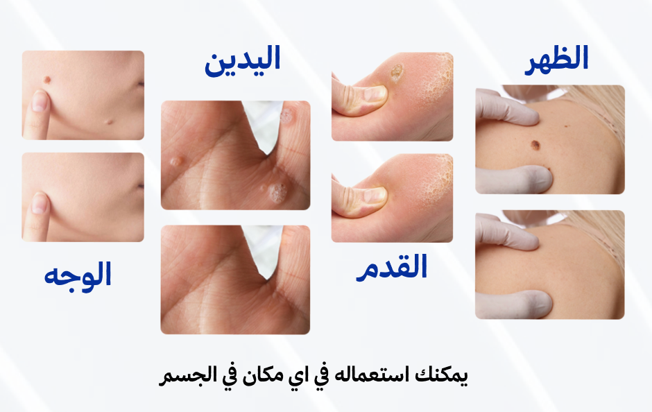 المرهم الاول في العالم لازالة الثآليل🌟 (نسخة) P8eq6HGyFUEHawYM8lmf5nd8MHxV1j4YMpdNZ3SM