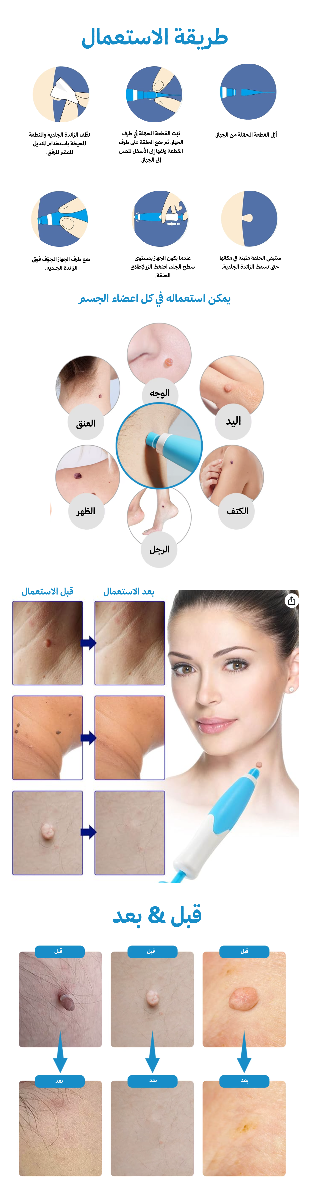 جهاز إزالة الثآليل بكل سهولة - بدون نزيف و لا ندوب و لا ألم 🌟🌟 QjQ9Yc5fYwxUJmPkWADZpurKuq9YVrjICxGrEAik