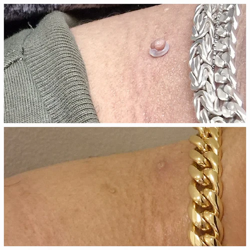 جهاز إزالة الثآليل بكل سهولة - بدون نزيف و لا ندوب و لا ألم 🌟🌟 TR1sM8u4AryjQBtNoMVORS9AeDvwtp6aiaVmG7s3