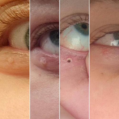 جهاز إزالة الثآليل بكل سهولة - بدون نزيف و لا ندوب و لا ألم 🌟🌟 Ukvybn1Cb1P5Zkejk1VjPCZ7QeT8AE6ZsuEYJoVr