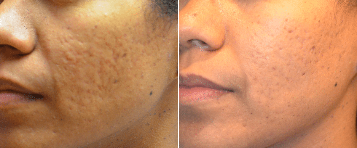 Dr Pen Ultima – dermapen de mésothérapie, microneedling M7 ultima, le meilleur rapport qualité/ prix, équipement de beauté professionnel, Micro aiguille, thérapie du système cutané