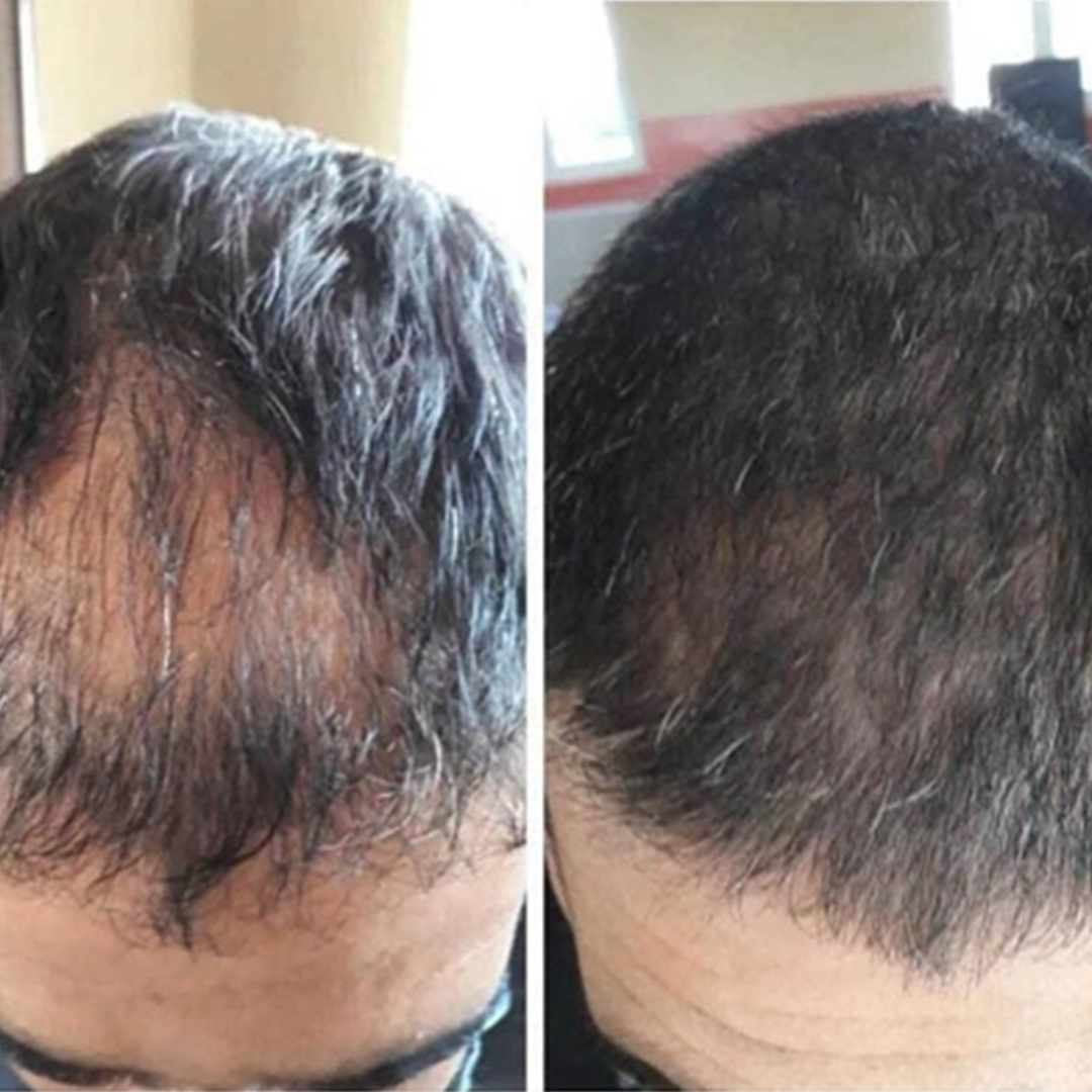 عرض 3 زيت الكافيين الأساسي المضاد لتساقط الشعر