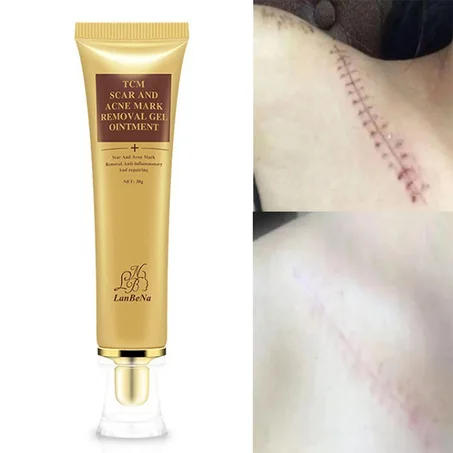 tcm scar جل إزالة الندبات
