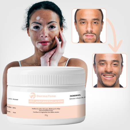 كريم العناية بالبشرة المتصبغة (البهاق)