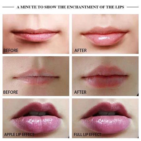 Electric Lip Plumper Device