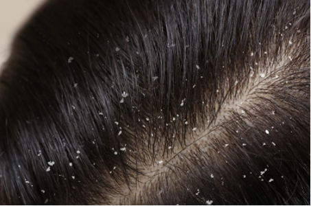 Dandruff & Dryness