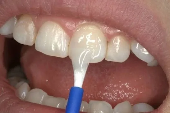 Fluoride Varnish