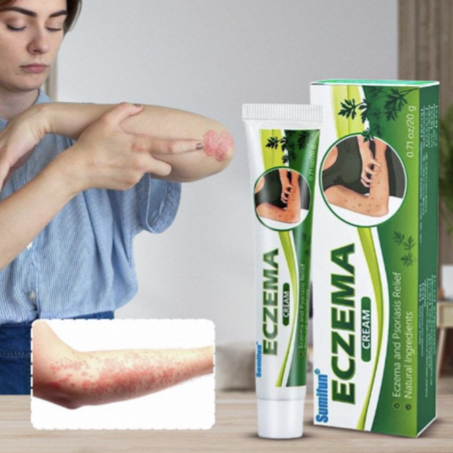 كريم الأكزيما والصدفية