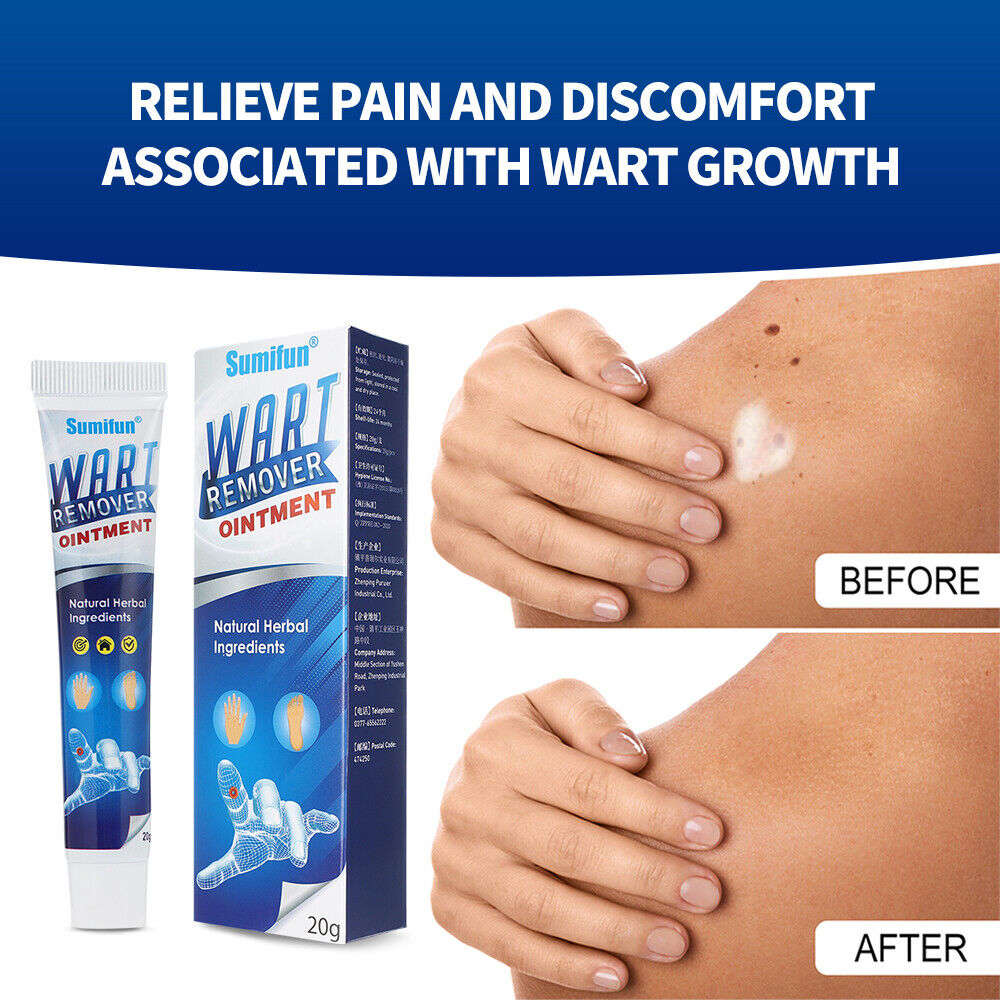 كريم إزالة الثآليل