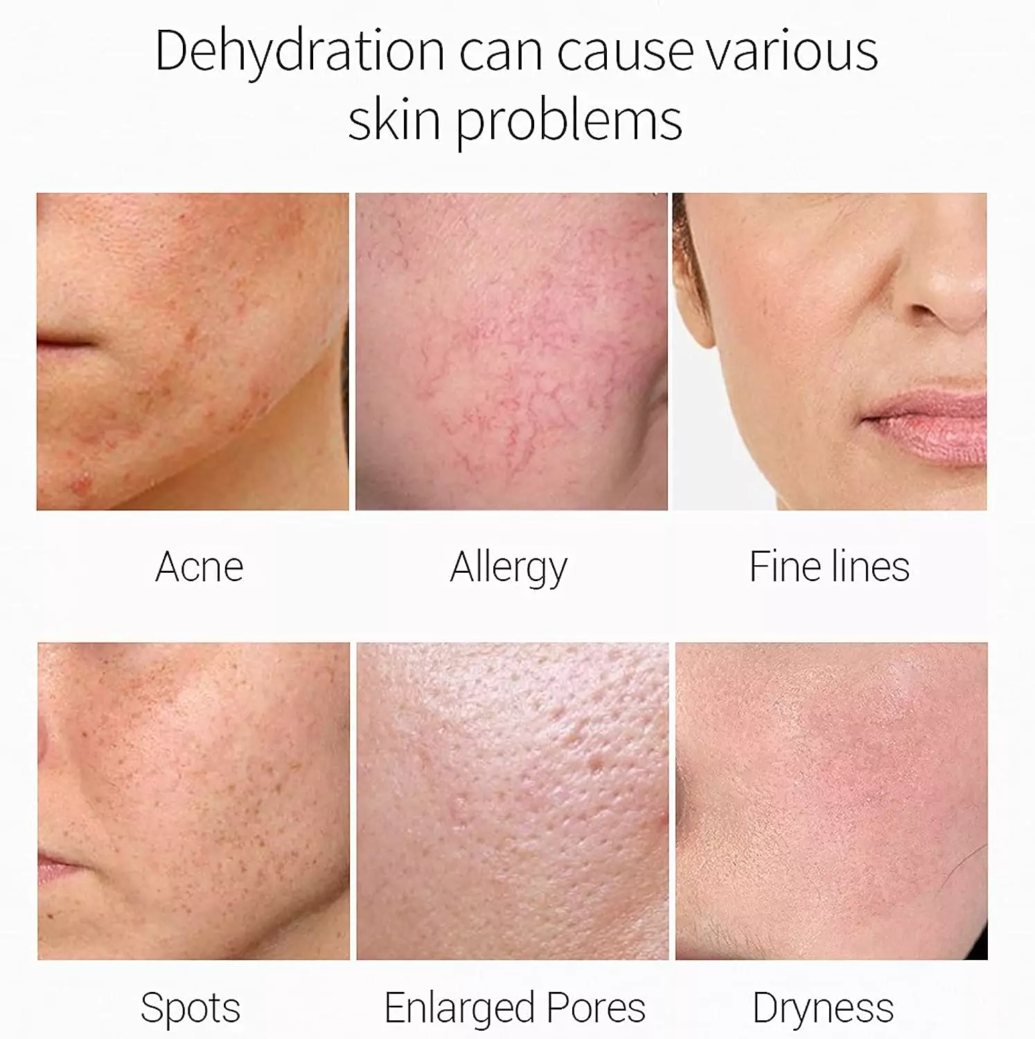 مصل لعلاج حب الشباب