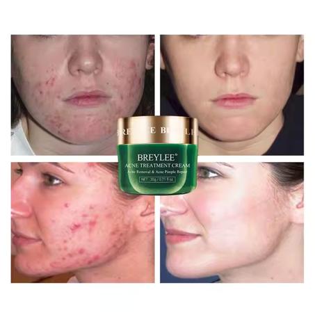 كريم بريلي لعلاج حب الشباب