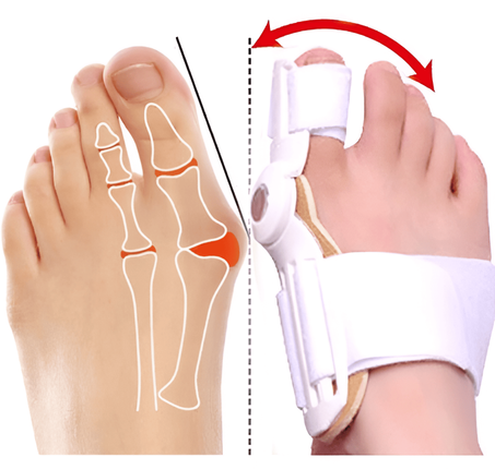 مصحح إبهام القدم (2 قطع)