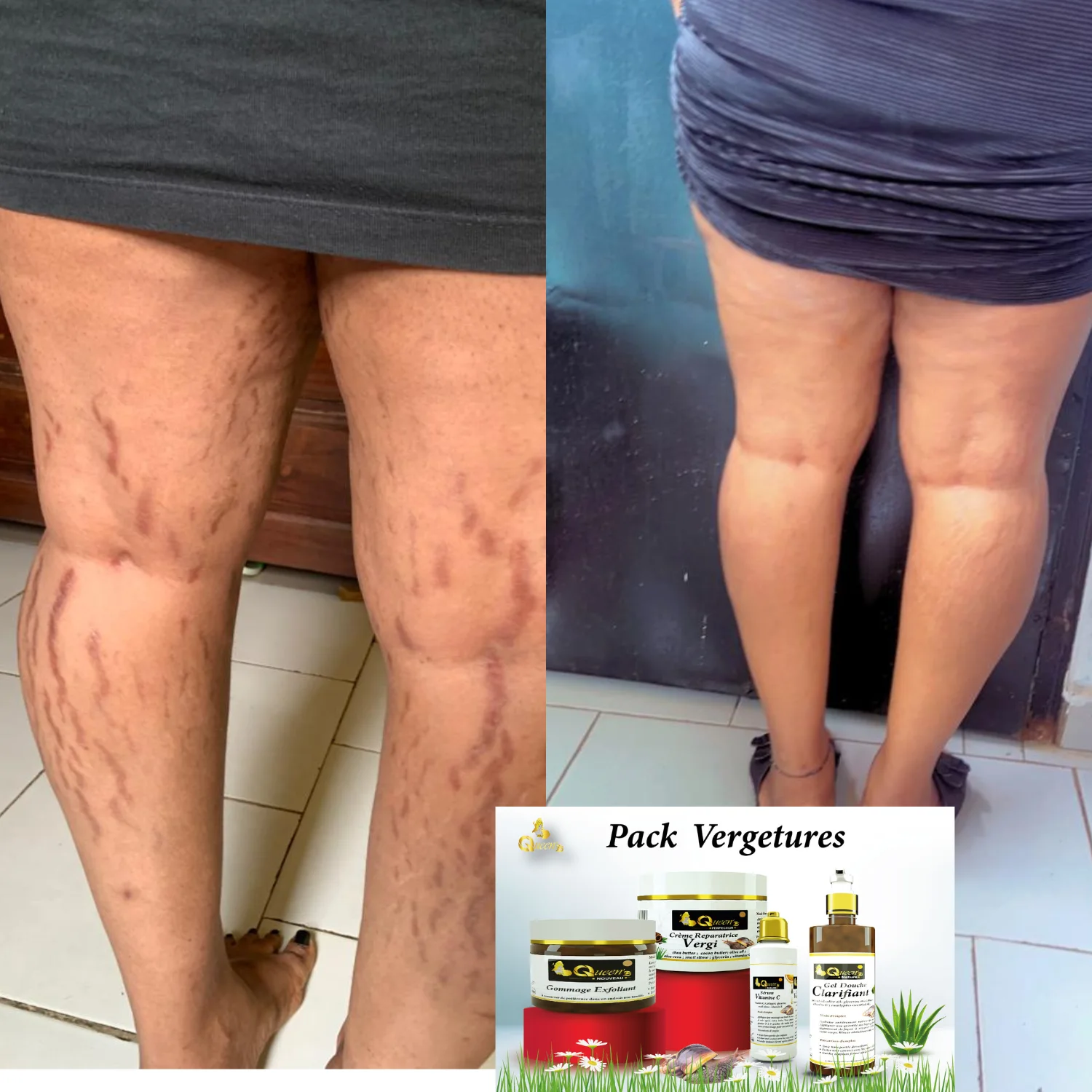 Packs vergetures : Dites totalement adieu aux vergetures avec notre solution 100% naturels