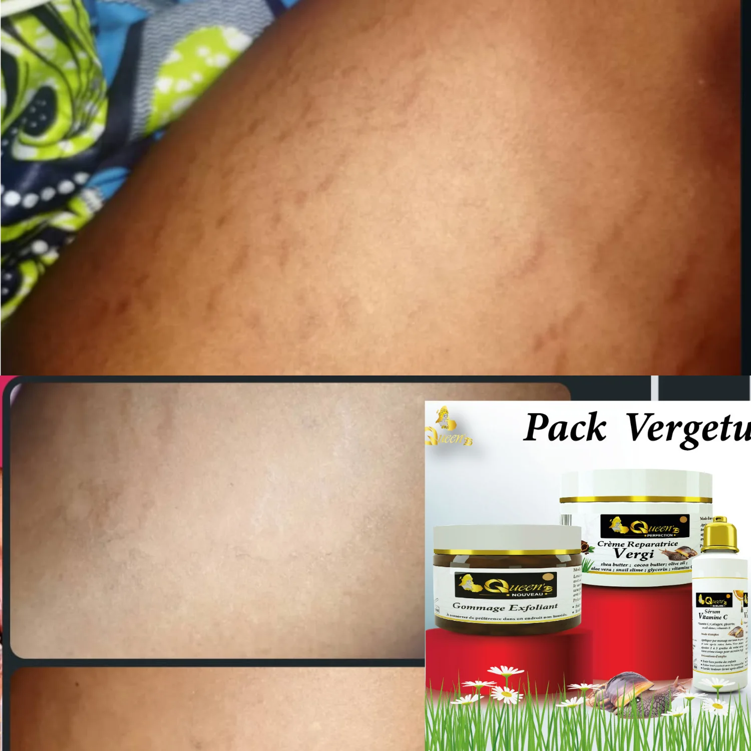 Packs vergetures : Dites totalement adieu aux vergetures avec notre solution 100% naturels