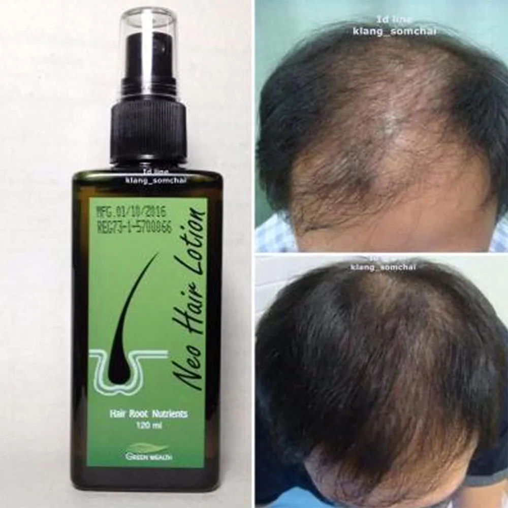 Neo hair lotion 120m لوشن نيو هيرلتجديد الشعر التالف 120 مل