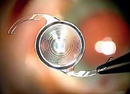 IMPLANTS Pliable ALCON