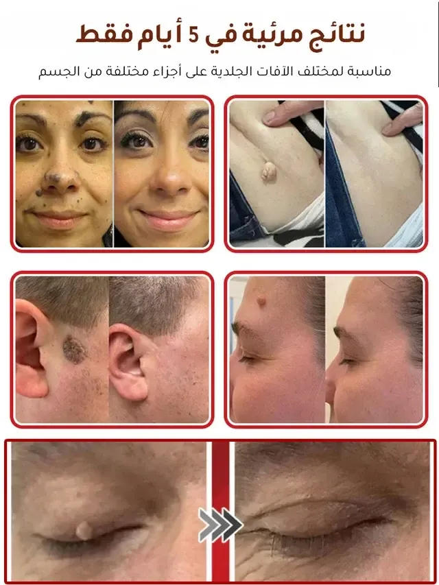 وداعًا للثآليل المزعجة بلا جراحة لاصقات العناية بالبشرة