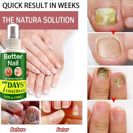 Spray de réparation des ongles