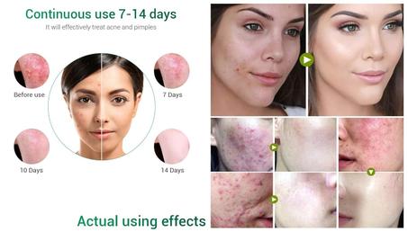 كريم علاج حب الشباب