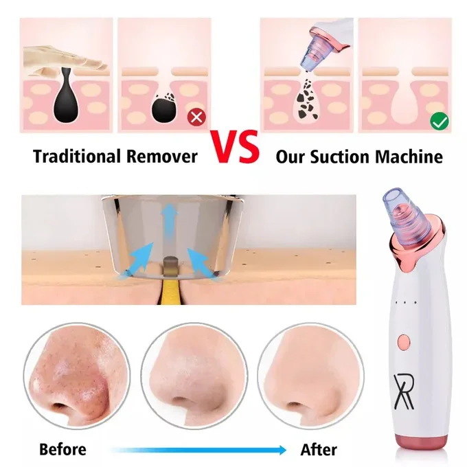 جهاز ازالة الرؤوس السوداء XR CLEANER