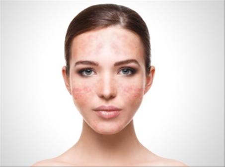 Peau Sujette à l'Acné