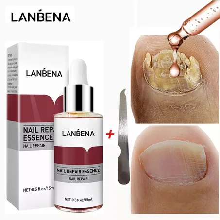 LANBENA – sérum de réparation des ongles, traitement antifongique, nourrissant, éclaircissant, pour les pieds et les mains