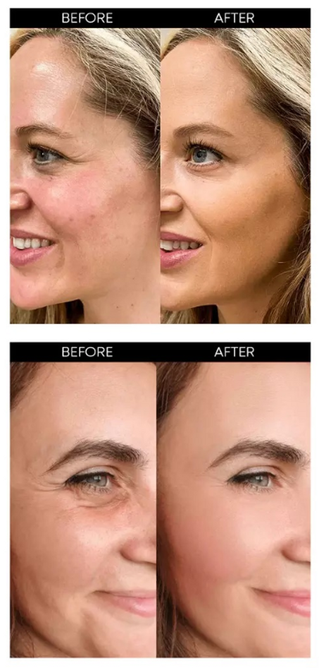 خيوط البروتين وبخاخ الكولاجين