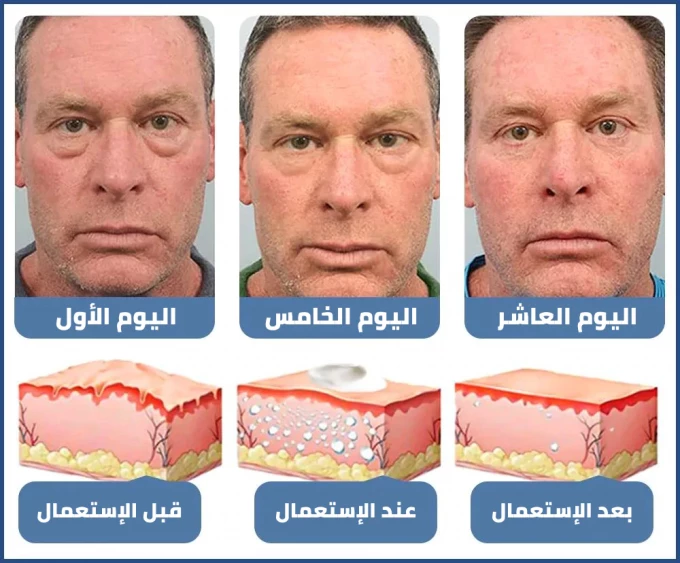 كريم ™Openeyes لعلاج التجاعيد