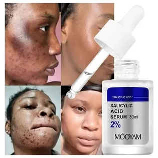 Fini les boutons et taches noires en 7 jours – Sérum Anti-Acné 30ml