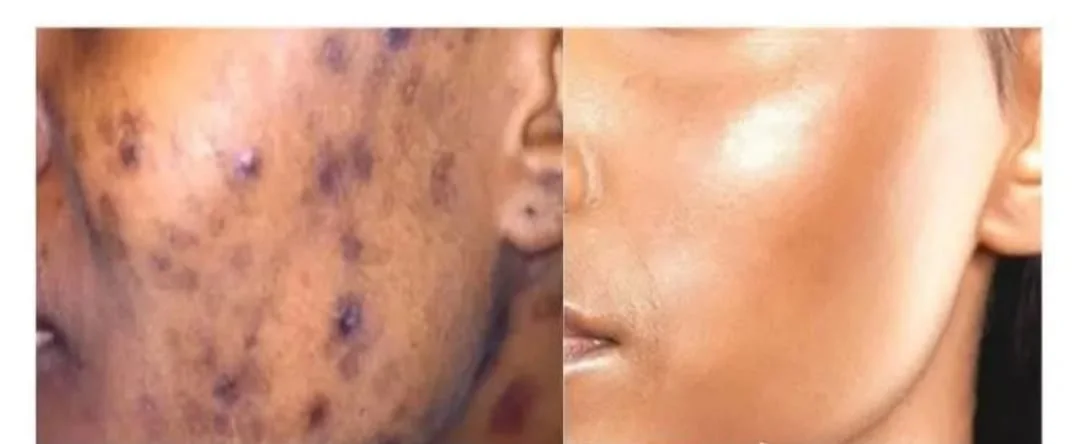 Fini les boutons et taches noires en 7 jours – Sérum Anti-Acné 30ml