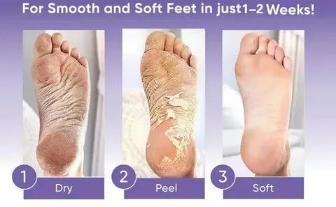 قناع تقشير القدمين