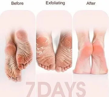 قناع تقشير القدمين