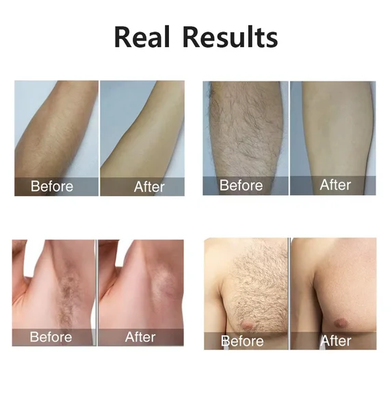 Laser Hair Removal Device