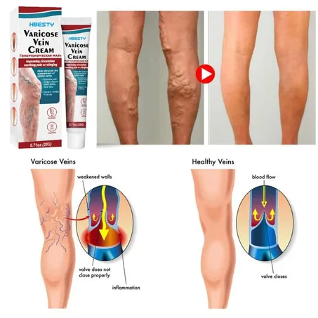 Crème Pour Soulager La Vascularite