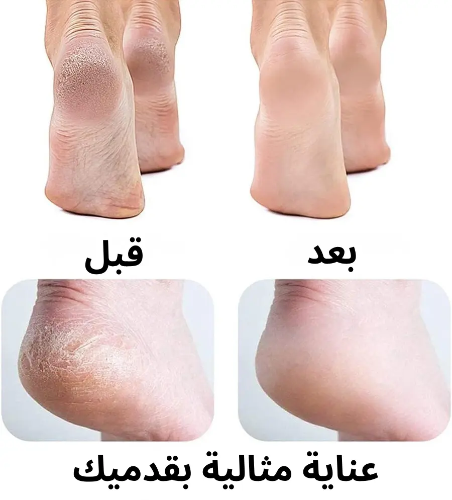 ✨ جهاز إزالة الجلد الميت للقدمين