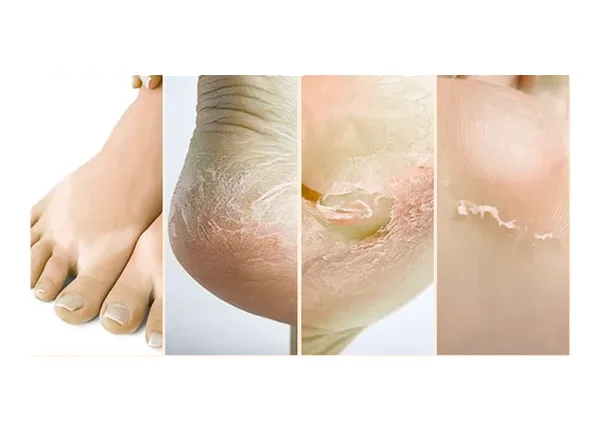 ⭐​⭐​⭐​⭐​⭐​  +2750 clientes satisfaites FOOT PEEL MASK™ - Retrouvez maintenant vos jolis pieds de bébé !