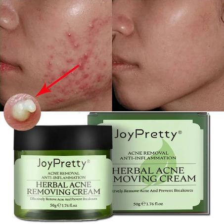 كريم الحماية من حب الشباب       Acne Protection Cream