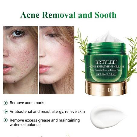Acne Treatment Cream
