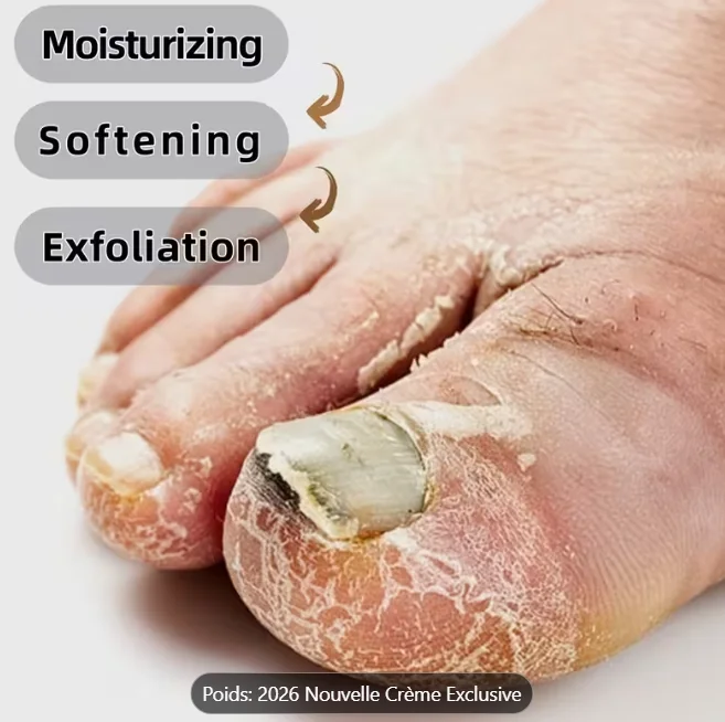 مزيل فطريات الاظافر