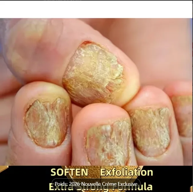 مزيل فطريات الاظافر