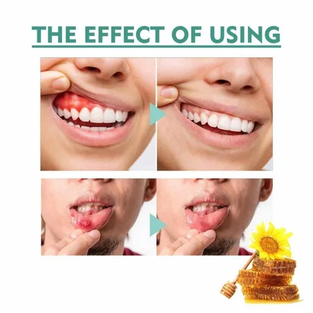 Le spray apaisant pour la bouche soulage les douleurs buccales brûlantes aphteuses