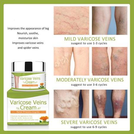 Varicose Veins Cream    كريم الدوالي