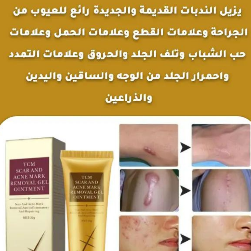 كريم إزالة الندبات ومزيل علامات التمدد وعلاج بقع حب الشباب وكريم تبييض